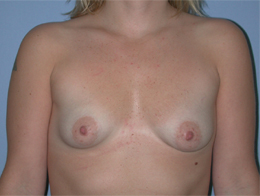 Before Image: Patient # 19985 - front