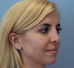 After Image: Patient # 54928 - front