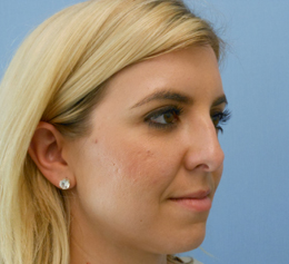 Before Image: Patient # 54928 - front