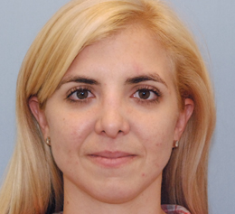 After Image: Patient # 54928 - front