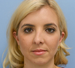 Before Image: Patient # 54928 - front