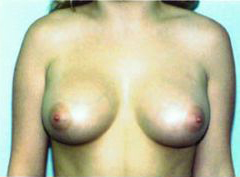 After Image: Patient # 54083 - front