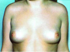 Before Image: Patient # 54083 - front
