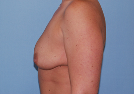 Before Image: Patient # 47847 - front
