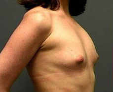Before Image: Patient # 32830 - front