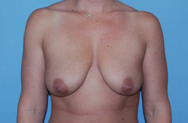 Before Image: Patient # 47847 - front