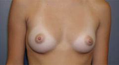 Before Image: Patient # 35595 - front