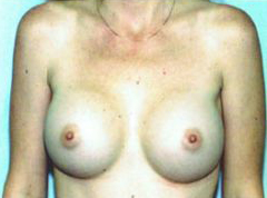 After Image: Patient # 22453 - front
