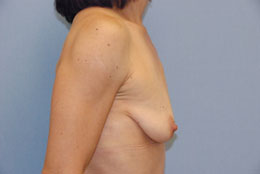 Before Image: Patient # 52004 - front