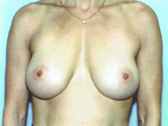 After Image: Patient # 61186 - front