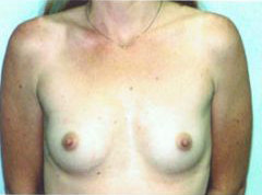 Before Image: Patient # 22453 - front