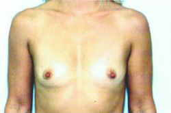 Before Image: Patient # 26849 - front