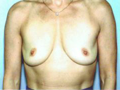 Before Image: Patient # 61186 - front