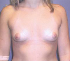 Before Image: Patient # 67391 - front