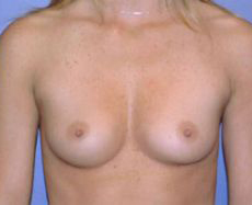Before Image: Patient # 62280 - front