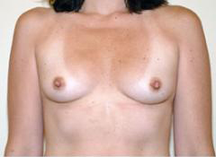 Before Image: Patient # 26995 - front