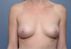Before Image: Patient # 74913 - front