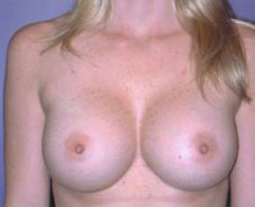 After Image: Patient # 62280 - front