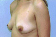 Before Image: Patient # 66385 - front