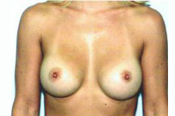 After Image: Patient # 26849 - front