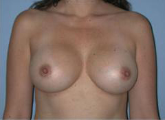 After Image: Patient # 26995 - front