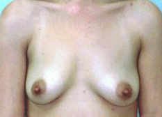Before Image: Patient # 66385 - front