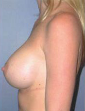 After Image: Patient # 92518 - front