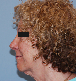 Before Image: Patient # 22029 - front