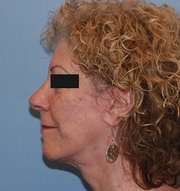 After Image: Patient # 59948 - front