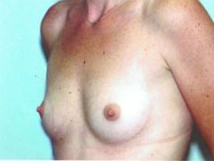 Before Image: Patient # 22453 - front