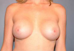 After Image: Patient # 74913 - front