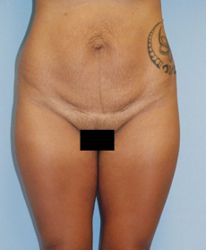 Before Image: Patient # 79886 - front