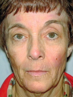 After Image: Patient # 25527 - front