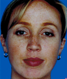 Before Image: Patient # 96128 - front