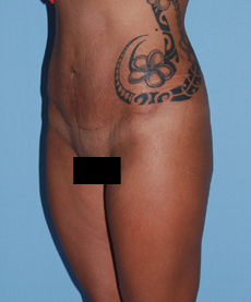 After Image: Patient # 79886 - front