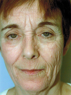Before Image: Patient # 25527 - front