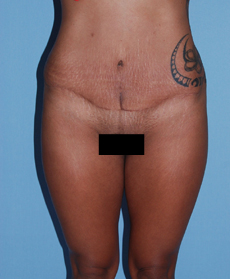 After Image: Patient # 79886 - front