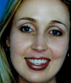 After Image: Patient # 96128 - front