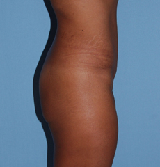 After Image: Patient # 79886 - front