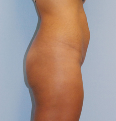 Before Image: Patient # 79886 - front