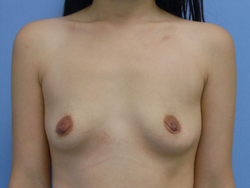 Before Image: Patient # 94329 - front