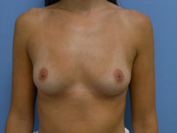 Before Image: Patient # 88196 - front
