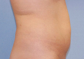 Before Image: Patient # 61890 - front