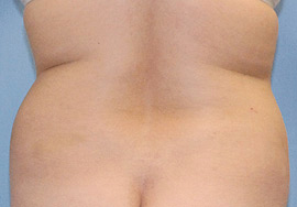 Before Image: Patient # 61890 - front