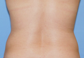 After Image: Patient # 61890 - front