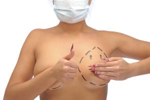 breast revision