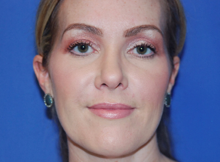 After Image: Patient # 64249 - front