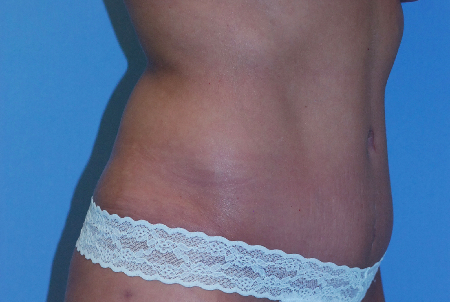 After Image: Patient # 31268 - front