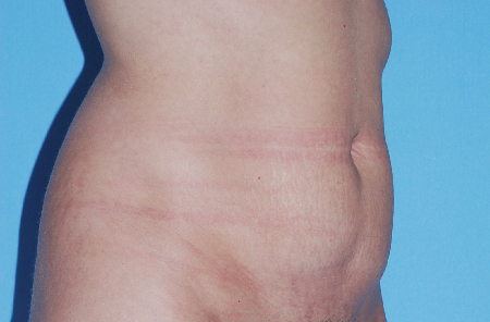 Before Image: Patient # 31268 - front