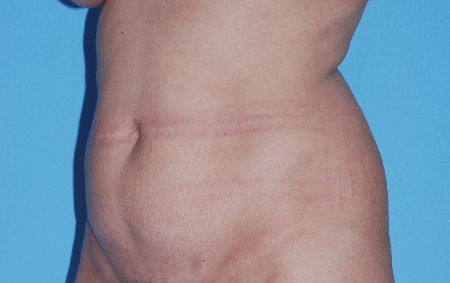Before Image: Patient # 31268 - front